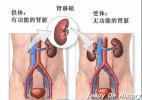 最早应用于人类的肾移植 肾移植术进入新的阶段