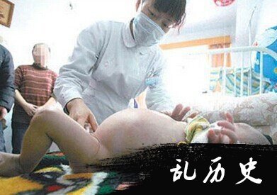 什么是胎中胎?孕妇生下胎中胎