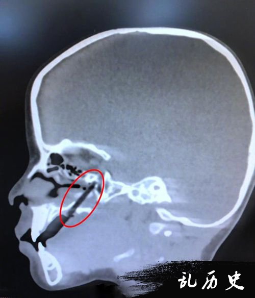 吃肉丸时半截筷子插入男童上颚