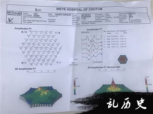 15岁男孩被激光笔灼伤后，视网膜黄斑区已经没有峰值，右边为正常视力的黄斑区，有峰值。