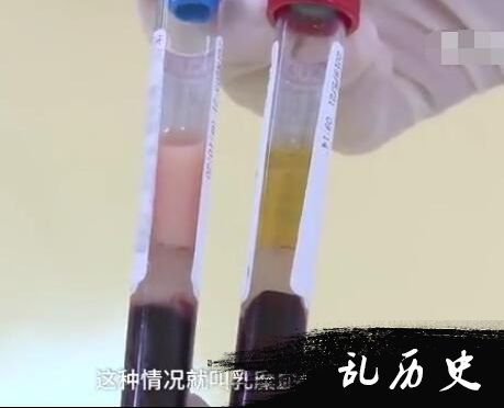 离心后的血清是乳白色的，医学上叫乳糜血